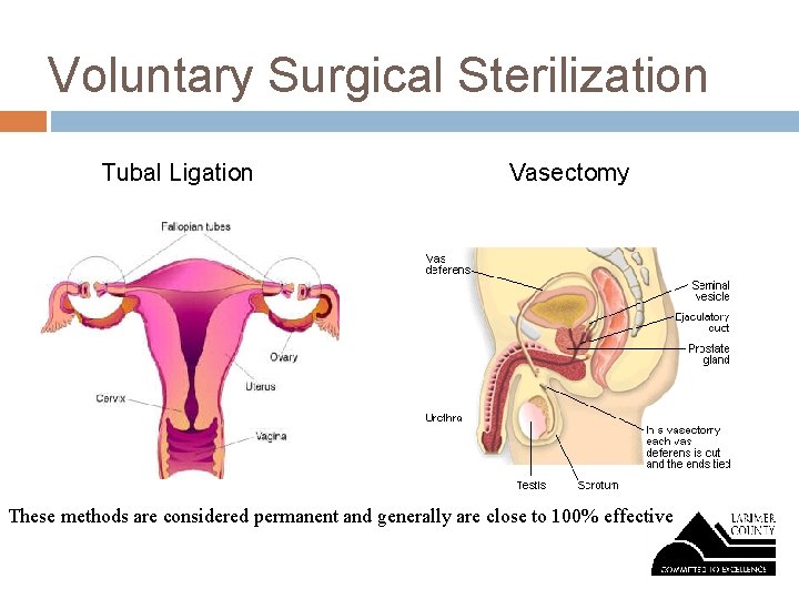 Voluntary Surgical Sterilization Tubal Ligation Vasectomy These methods are considered permanent and generally are