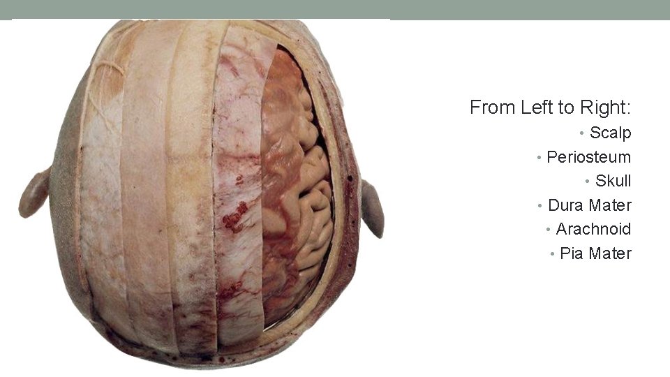From Left to Right: • Scalp • Periosteum • Skull • Dura Mater •