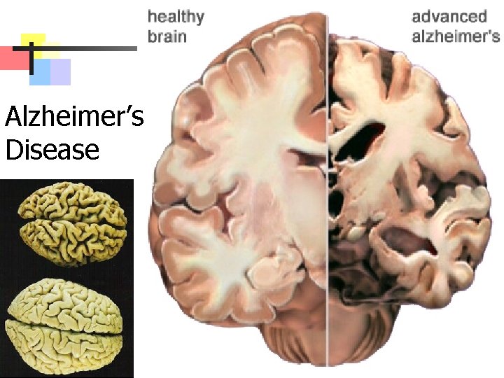 Alzheimer’s Disease 