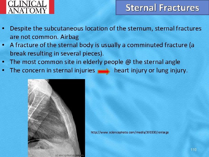 Sternal Fractures • Despite the subcutaneous location of the sternum, sternal fractures are not