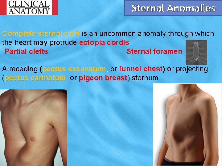 Sternal Anomalies Complete sternal cleft is an uncommon anomaly through which the heart may