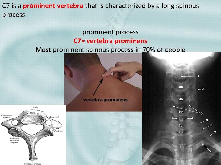 C 7 is a prominent vertebra that is characterized by a long spinous process.