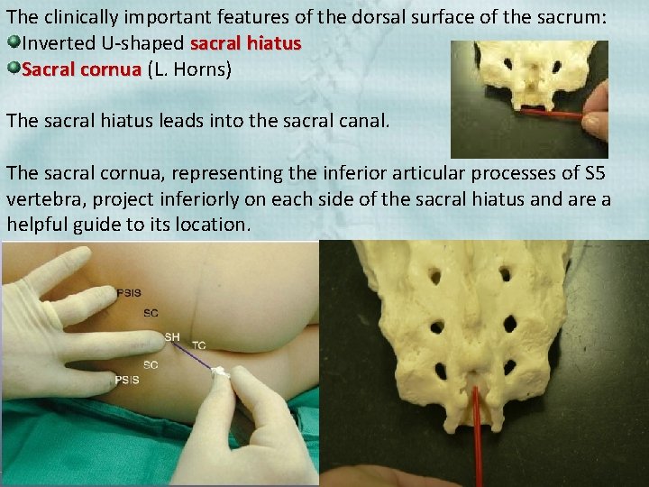 The clinically important features of the dorsal surface of the sacrum: Inverted U-shaped sacral