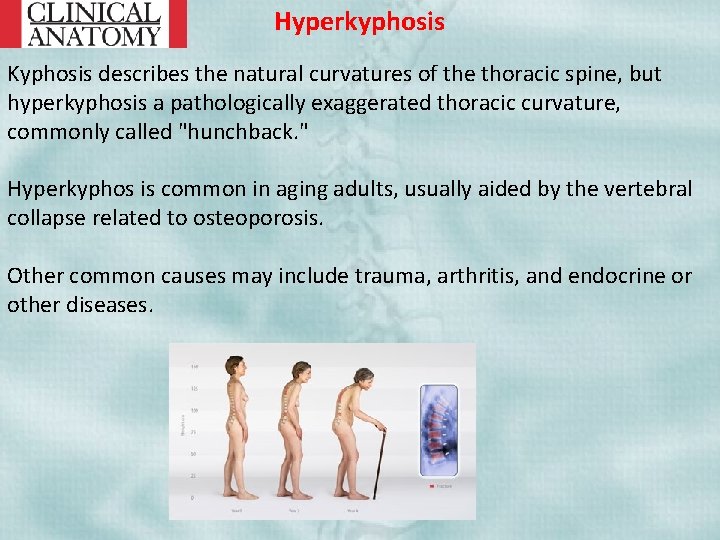 Hyperkyphosis Kyphosis describes the natural curvatures of the thoracic spine, but hyperkyphosis a pathologically