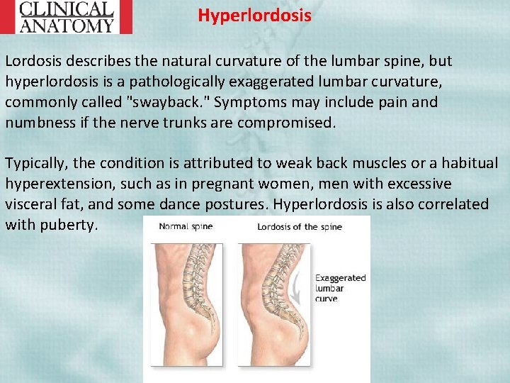 Hyperlordosis Lordosis describes the natural curvature of the lumbar spine, but hyperlordosis is a