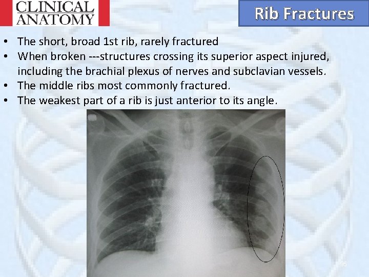 Rib Fractures • The short, broad 1 st rib, rarely fractured • When broken