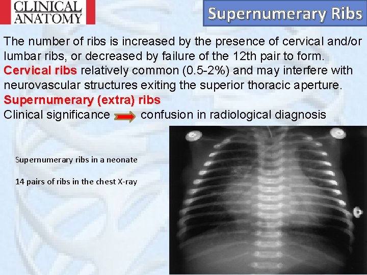 Supernumerary Ribs The number of ribs is increased by the presence of cervical and/or