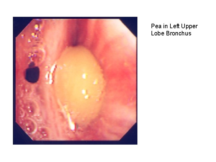 Pea in Left Upper Lobe Bronchus 