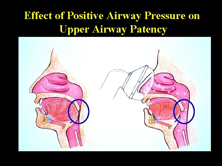 Effect of Positive Airway Pressure on Upper Airway Patency 