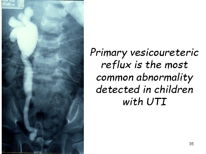 Primary vesicoureteric reflux is the most common abnormality detected in children with UTI 35