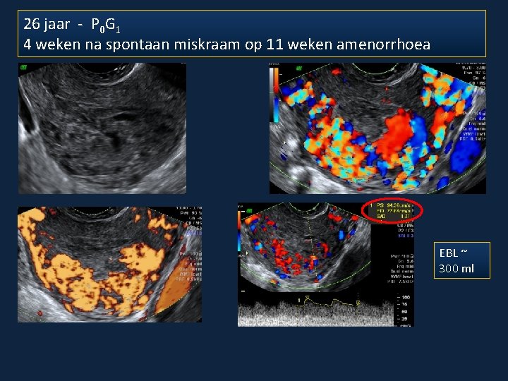 26 jaar - P 0 G 1 4 weken na spontaan miskraam op 11