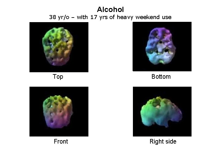 Alcohol 38 yr/o – with 17 yrs of heavy weekend use Top Bottom Front