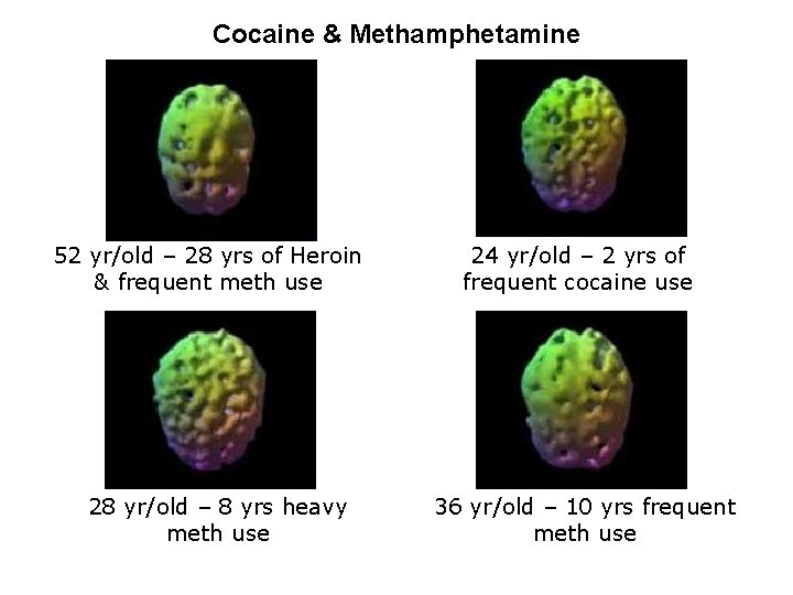 Cocaine & Methamphetamine 52 yr/old – 28 yrs of Heroin & frequent meth use