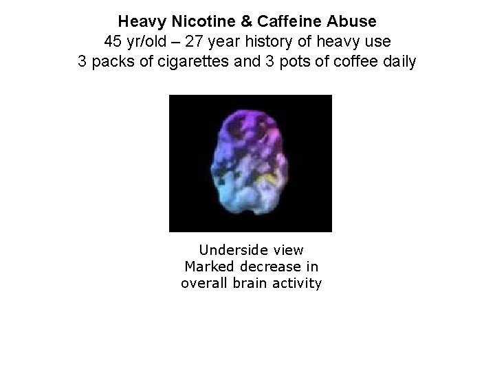 Heavy Nicotine & Caffeine Abuse 45 yr/old – 27 year history of heavy use