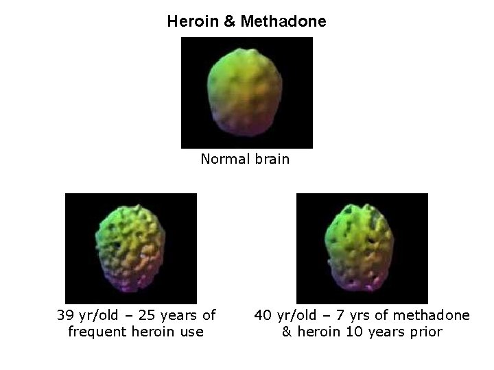 Heroin & Methadone Normal brain 39 yr/old – 25 years of frequent heroin use