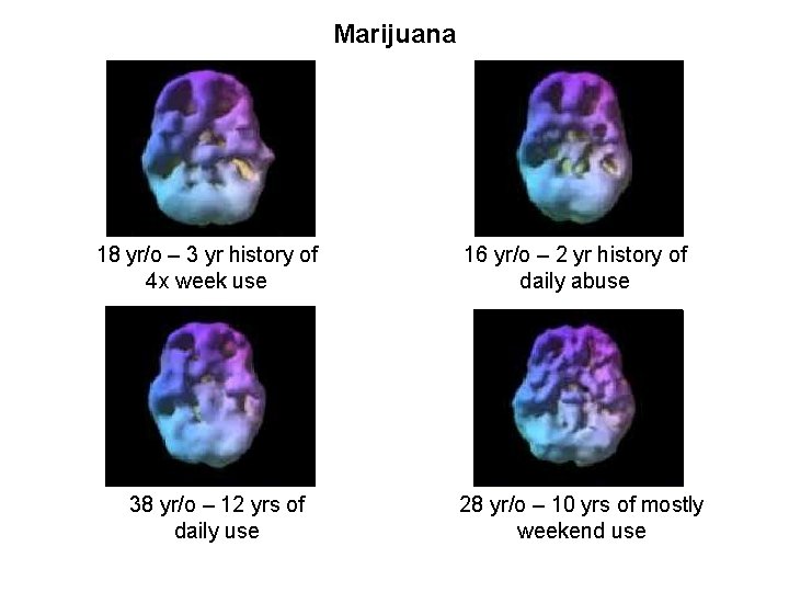 Marijuana 18 yr/o – 3 yr history of 4 x week use 38 yr/o