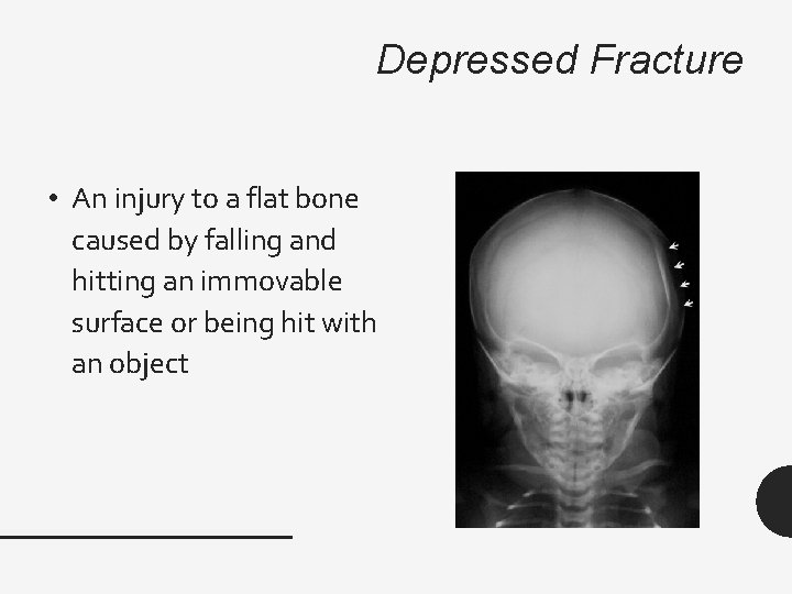 Depressed Fracture • An injury to a flat bone caused by falling and hitting