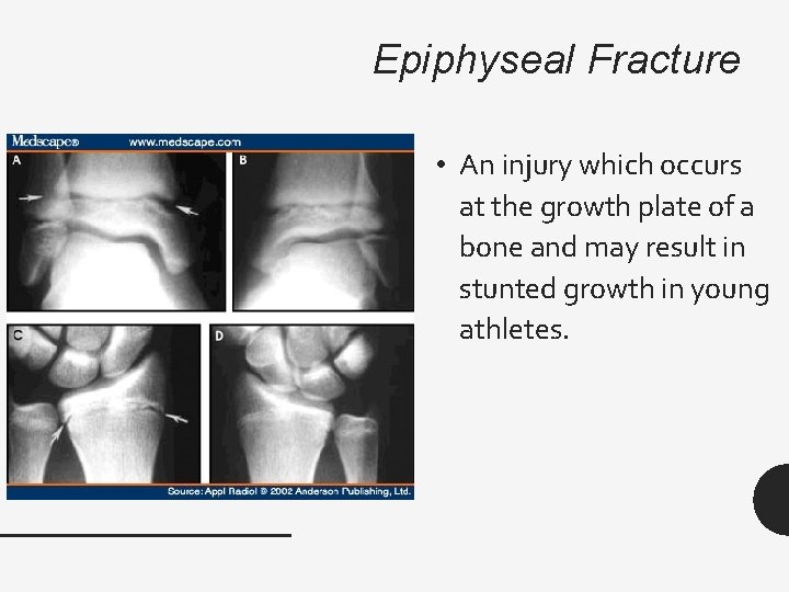 Epiphyseal Fracture • An injury which occurs at the growth plate of a bone