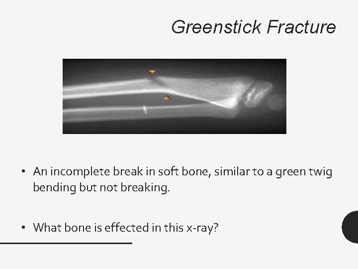 Greenstick Fracture • An incomplete break in soft bone, similar to a green twig