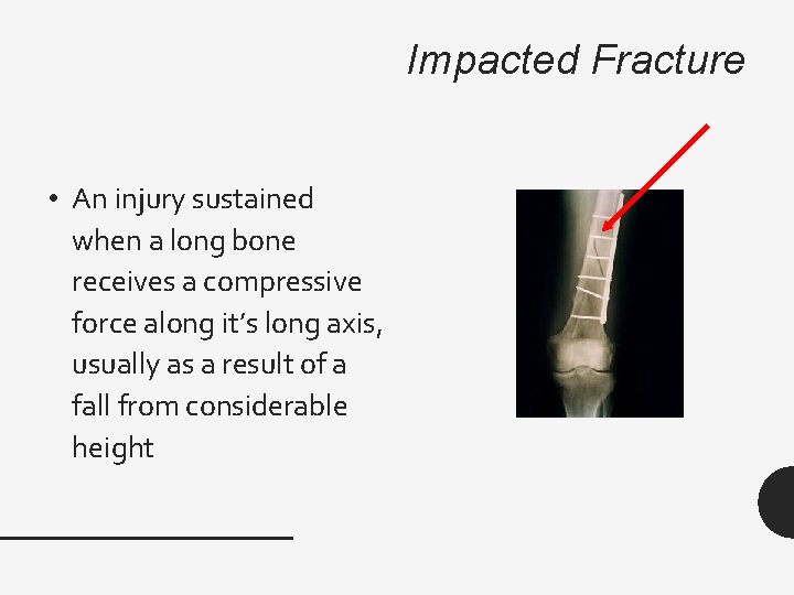 Impacted Fracture • An injury sustained when a long bone receives a compressive force