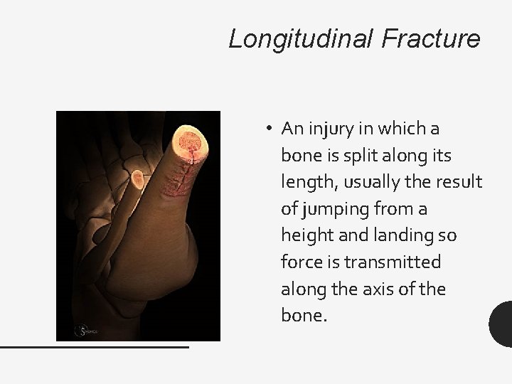 Longitudinal Fracture • An injury in which a bone is split along its length,