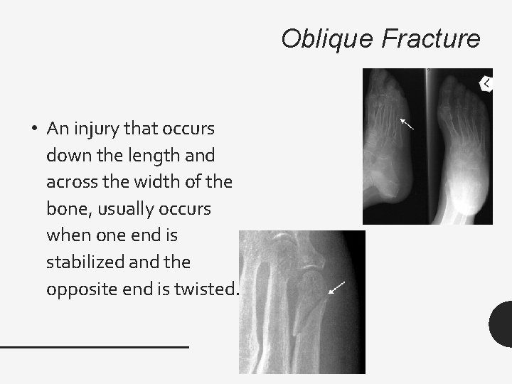 Oblique Fracture • An injury that occurs down the length and across the width