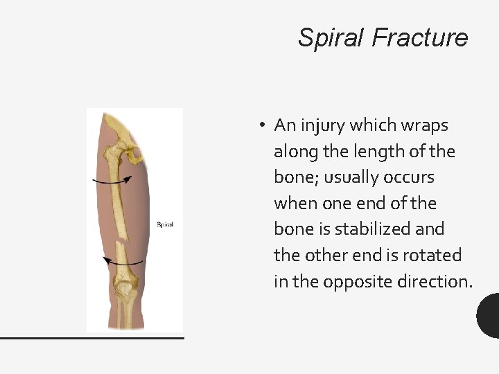 Spiral Fracture • An injury which wraps along the length of the bone; usually