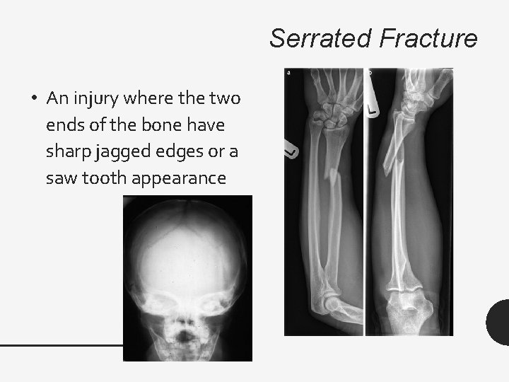 Serrated Fracture • An injury where the two ends of the bone have sharp