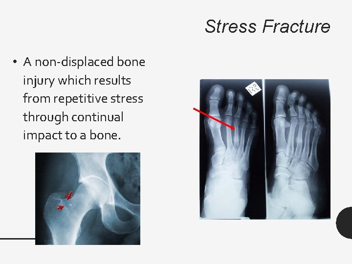 Stress Fracture • A non-displaced bone injury which results from repetitive stress through continual