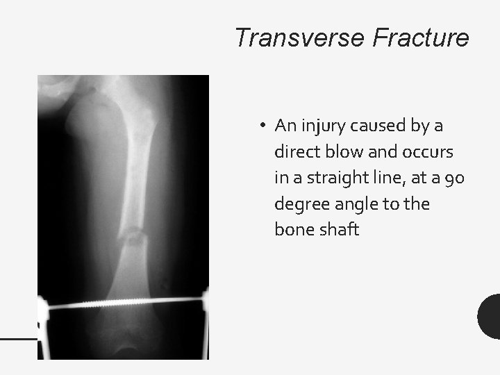 Transverse Fracture • An injury caused by a direct blow and occurs in a