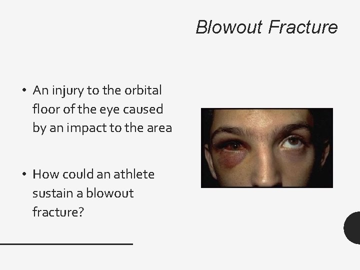 Blowout Fracture • An injury to the orbital floor of the eye caused by