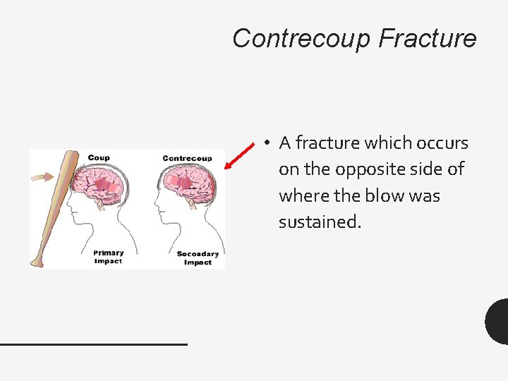 Contrecoup Fracture • A fracture which occurs on the opposite side of where the