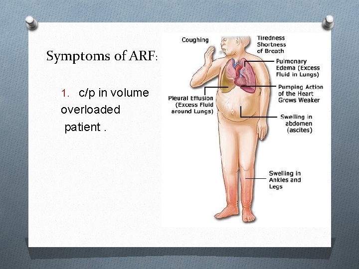 Symptoms of ARF: 1. c/p in volume overloaded patient. 