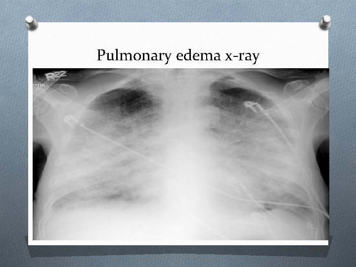 Pulmonary edema x-ray 