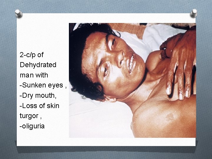 2 -c/p of Dehydrated man with -Sunken eyes , -Dry mouth, -Loss of skin