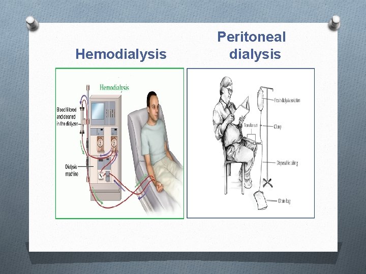 Hemodialysis Peritoneal dialysis 
