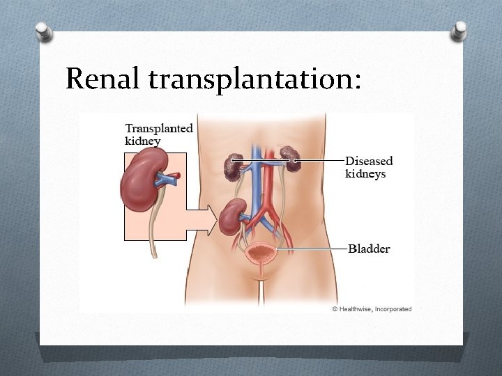 Renal transplantation: 