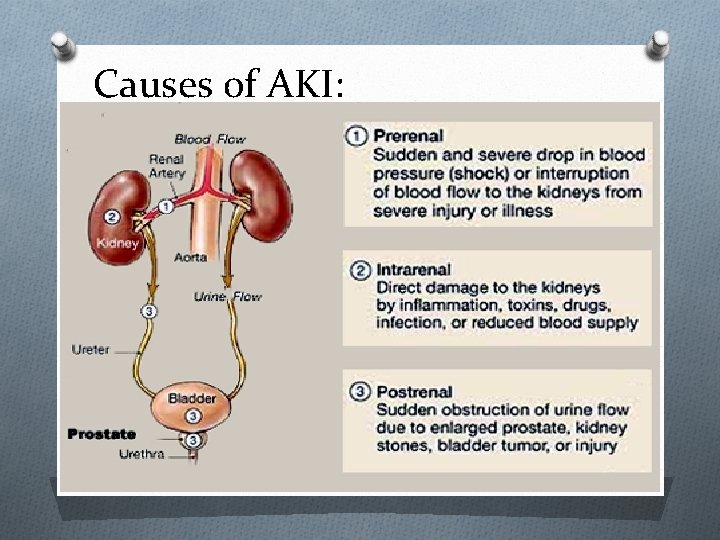 Causes of AKI: 