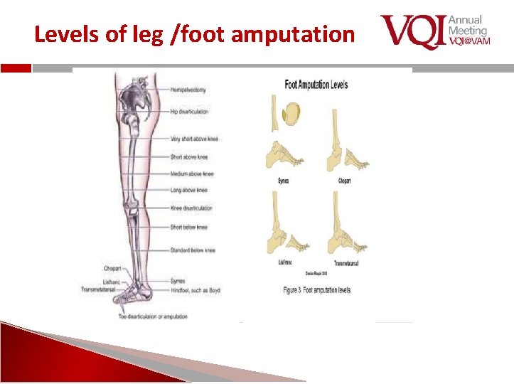 Levels of leg /foot amputation 