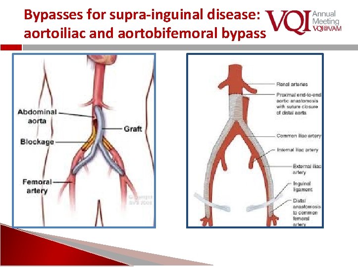 Bypasses for supra-inguinal disease: aortoiliac and aortobifemoral bypass 
