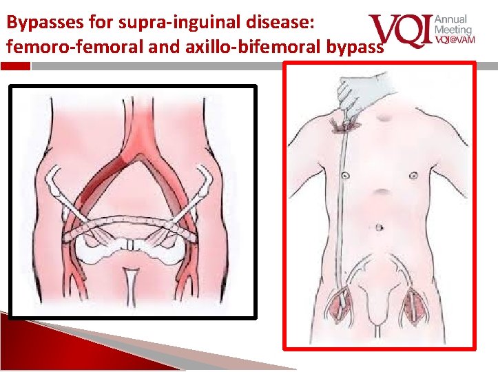 Bypasses for supra-inguinal disease: femoro-femoral and axillo-bifemoral bypass 