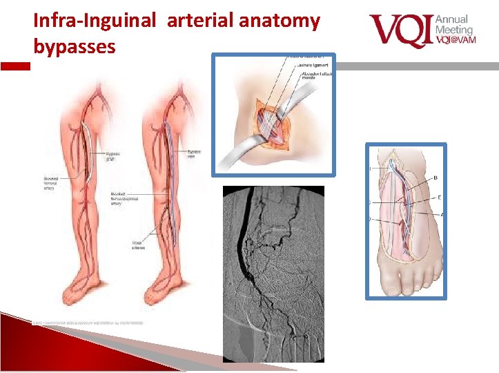 Infra-Inguinal arterial anatomy bypasses 