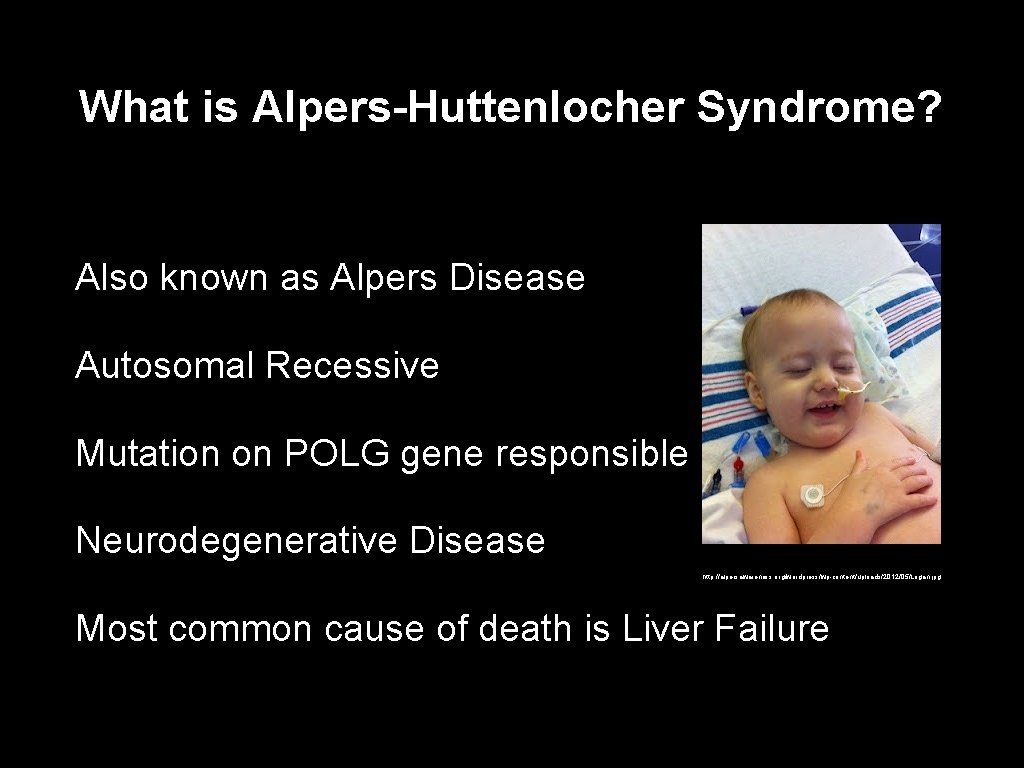 What is Alpers-Huttenlocher Syndrome? Also known as Alpers Disease Autosomal Recessive Mutation on POLG