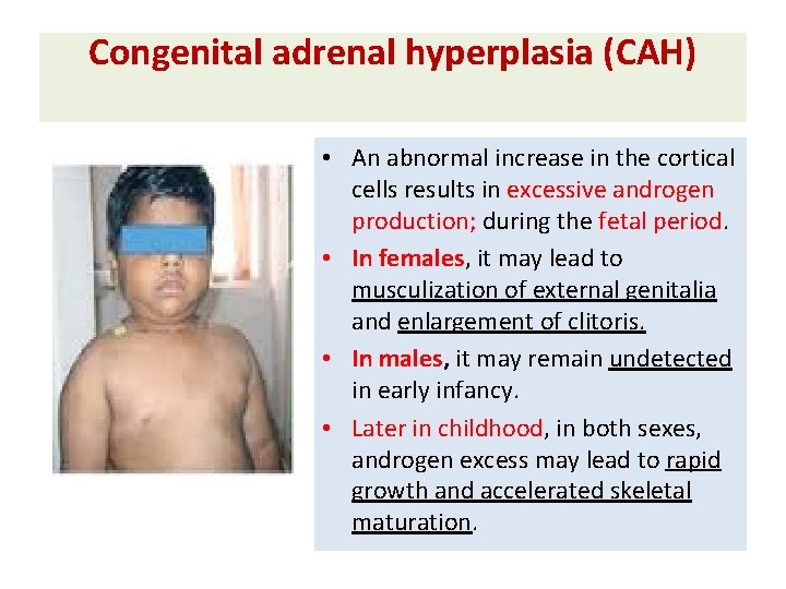 Congenital adrenal hyperplasia (CAH) • An abnormal increase in the cortical cells results in