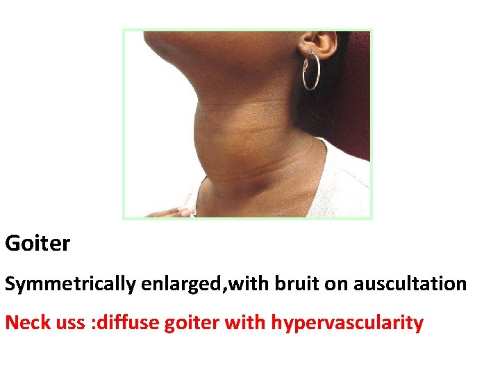 Goiter Symmetrically enlarged, with bruit on auscultation Neck uss : diffuse goiter with hypervascularity