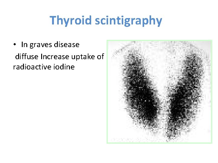 Thyroid scintigraphy • In graves disease diffuse Increase uptake of radioactive iodine 