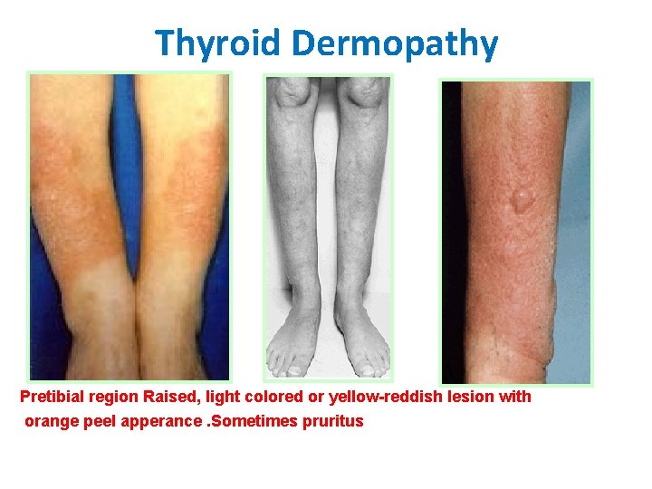 Thyroid Dermopathy Pretibial region Raised, light colored or yellow-reddish lesion with orange peel apperance.