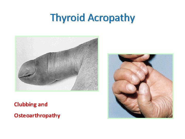 Thyroid Acropathy Clubbing and Osteoarthropathy 