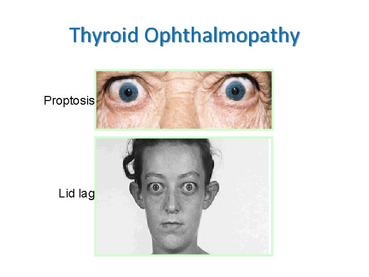 Thyroid Ophthalmopathy Proptosis Lid lag 