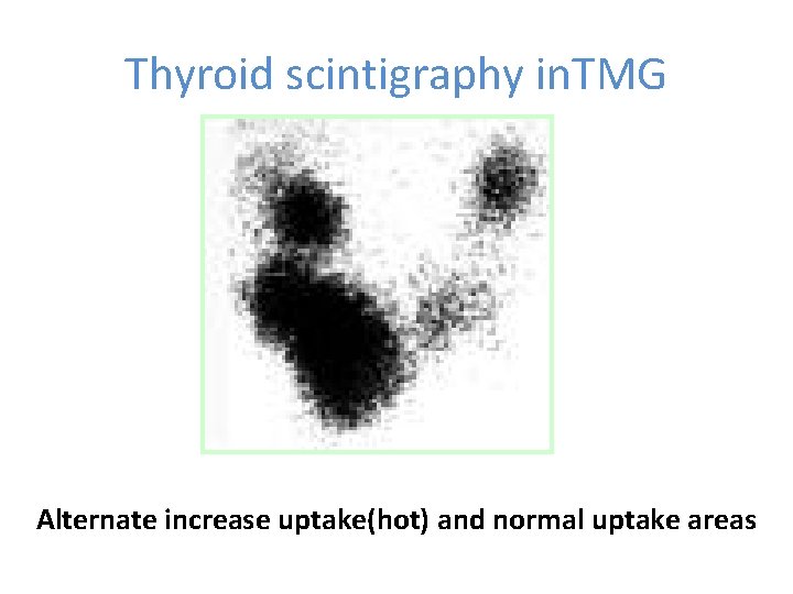 Thyroid scintigraphy in. TMG Alternate increase uptake(hot) and normal uptake areas 